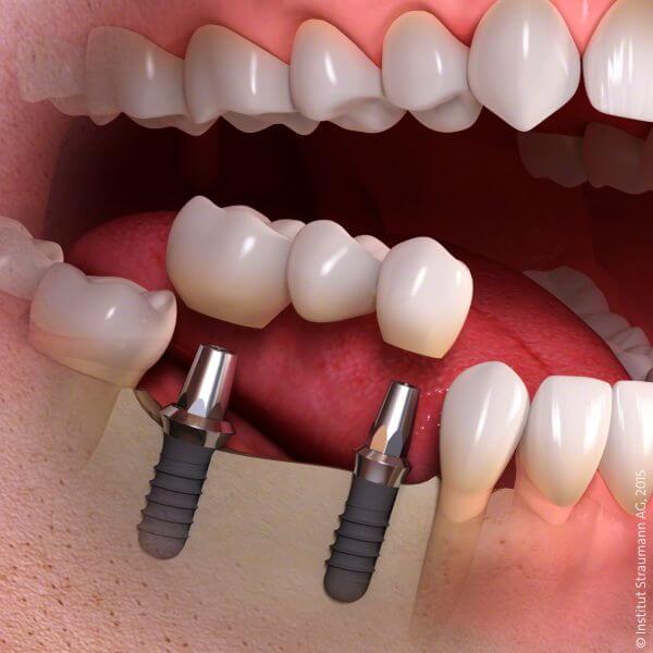Günstige Zahnbrücken auf Zahnimplantaten