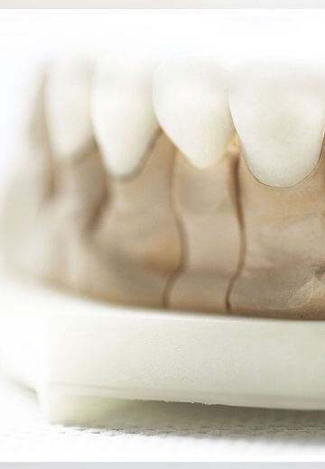 Vollkeramische Zahnkrone und Zirkon Zahnersatz