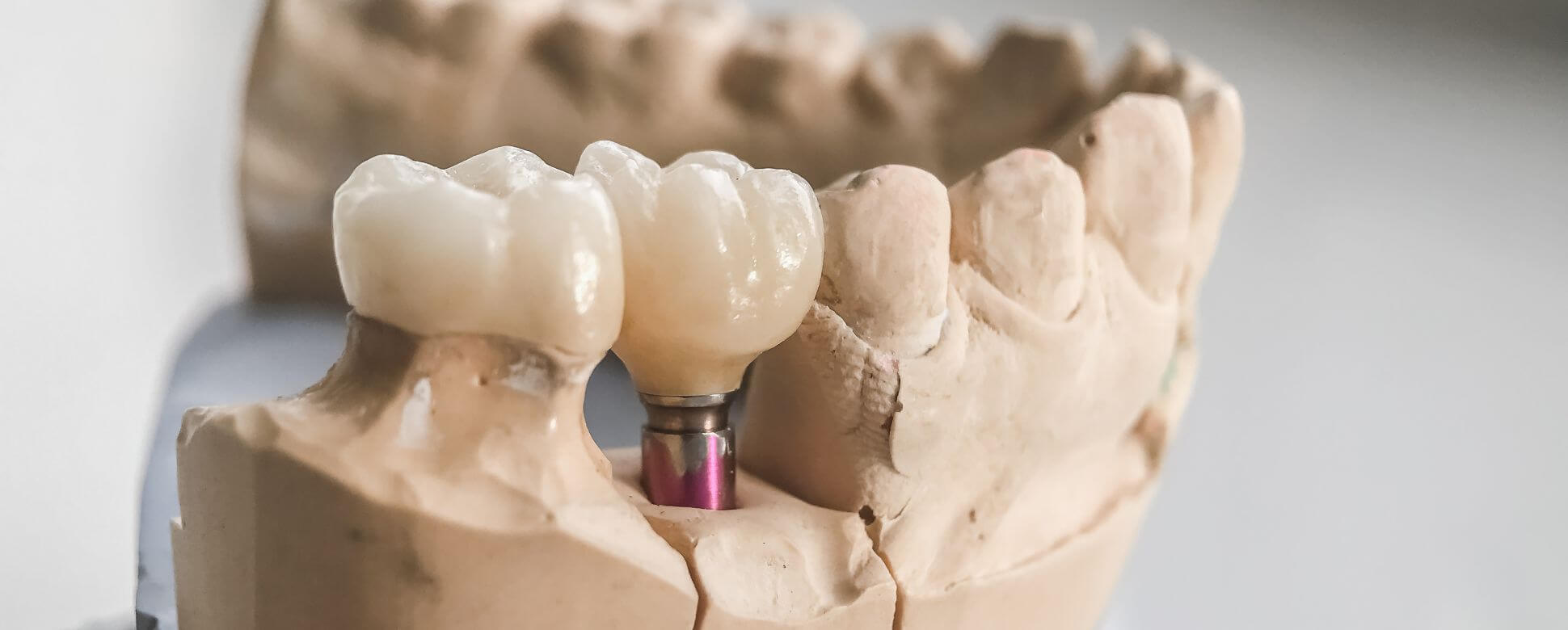 Keramikkrone auf einem Implantat und eigenem Zahn