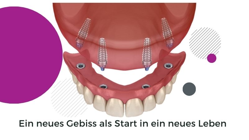 Eine Zahnprothese für Oberkiefer und Unterkiefer | implant24.com